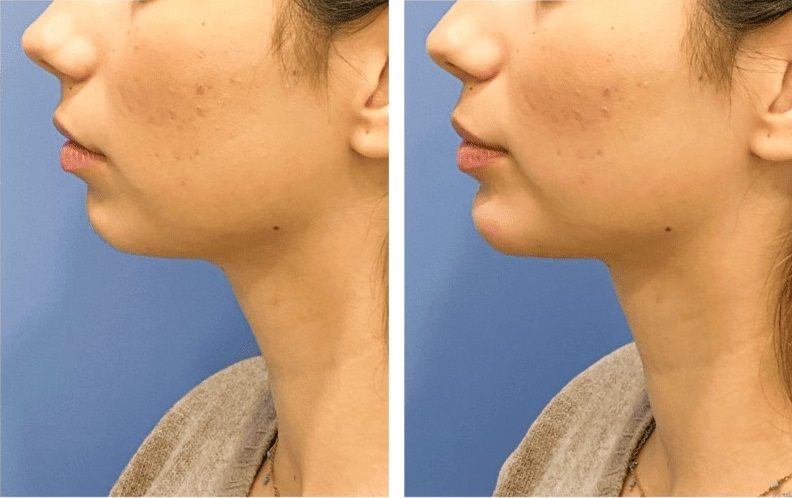 Mentoplastia caso 4 — antes y después